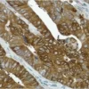 Colon cancer: COX-2 rabbit monoclonal antibody detected with ImmPRESS Universal Reagent and DAB substrate (brown). Hematoxylin QS counterstain (blue). Formalin-fixed, paraffin embedded tissue section.