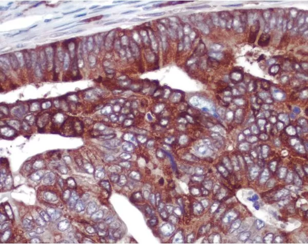 Colon cancer: COX-2 rabbit monoclonal antibody detected with ImmPRESS Universal Reagent and Vector NovaRED substrate (red). Hematoxylin QS counterstain (blue). Formalin-fixed, paraffin embedded tissue section.