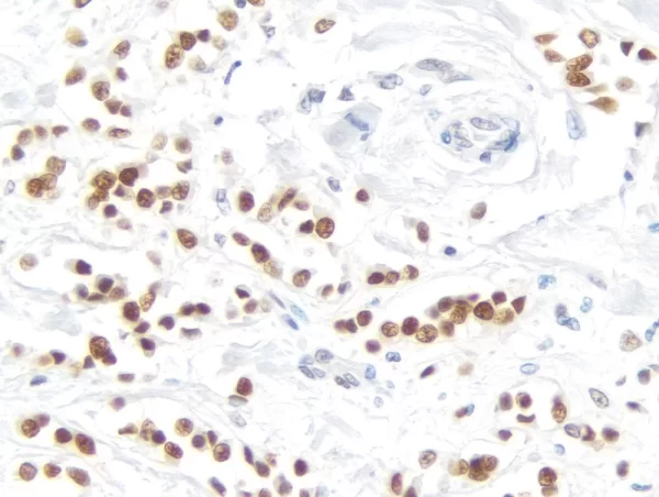 Breast Carcinoma: Progesterone Receptor (rm), ImmPRESS Universal Antibody Kit, DAB Substrate Kit (brown). Hematoxylin QS counterstain (blue).