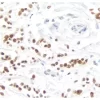 Breast Carcinoma: Progesterone Receptor (rm), ImmPRESS Universal Antibody Kit, DAB Substrate Kit (brown). Hematoxylin QS counterstain (blue).