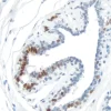 Breast Carcinoma: Progesterone Receptor (rm), ImmPRESS Universal Antibody Kit, DAB Substrate Kit (brown). Hematoxylin counterstain (blue). Breast Carcinoma:  Progesterone Receptor (rm), ImmPRESS Universal Antibody Kit, DAB Substrate Kit (brown).  Hematoxylin counterstain (blue).