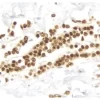 Breast Carcinoma: Estrogen Receptor (rm), ImmPRESS Universal Antibody Kit, DAB substrate Kit (brown). Hematoxylin QS counterstain (blue).