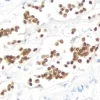 Breast Carcinoma: Estrogen Receptor (rm), ImmPRESS Universal Antibody Kit, DAB substrate Kit (brown). Hematoxylin QS counterstain (blue). Breast Carcinoma:  Estrogen Receptor (rm), ImmPRESS Universal Antibody Kit, DAB substrate Kit (brown).  Hematoxylin QS counterstain (blue).
