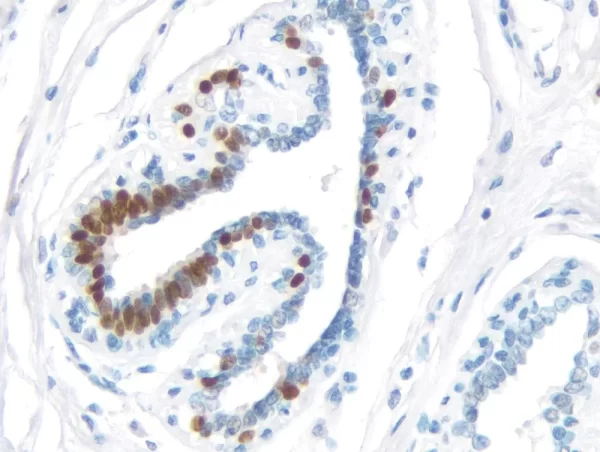 Breast Carcinoma: Estrogen Receptor (rm), ImmPRESS Universal Antibody Kit, DAB substrate Kit (brown). Hematoxylin QS counterstain (blue). Breast Carcinoma:  Estrogen Receptor (rm), ImmPRESS Universal Antibody Kit, DAB substrate Kit (brown).  Hematoxylin QS counterstain (blue).