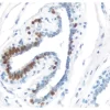 Breast Carcinoma: Progesterone Receptor (rm), ImmPRESS Universal Antibody Kit, DAB Substrate Kit (brown). Hematoxylin counterstain (blue).