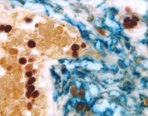 Breast Carcinoma (triple label): Estrogen Receptor (m), VECTASTAIN Elite ABC Kit, Vector NovaRED substrate (red); CD34 (m), VECTASTAIN ABC-AP Kit, Vector Blue substrate (blue); Cytokeratin 8/18 (m), VECTASTAIN Elite ABC Kit, DAB substrate (brown).