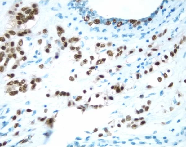 Breast: Estrogen Receptor (m), ImmPRESS Anti-Mouse Ig Kit, DAB Substrate Kit (brown). Hematoxylin counterstain (blue).
