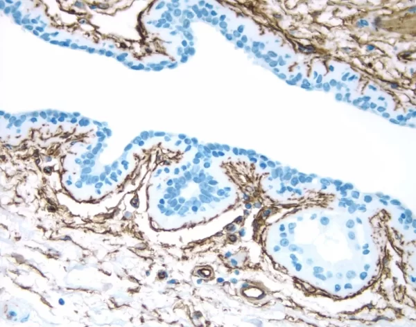 Breast: Estrogen Receptor (m), ImmPRESS Anti-Mouse Ig Kit, DAB Substrate Kit (brown). Hematoxylin counterstain (blue).