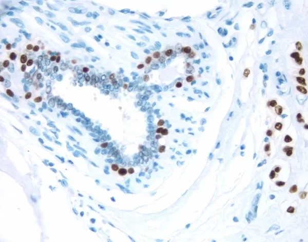 Breast Cancer: Estrogen receptor stained using VECTASTAIN Elite ABC Kit and Vector DAB (brown) substrate. Hematoxylin QS (blue) counterstain. Breast Cancer:  Estrogen receptor stained using VECTASTAIN Elite ABC Kit and Vector DAB (brown) substrate.  Hematoxylin QS (blue) counterstain.