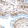 Breast Cancer: CD34 antigen stained using VECTASTAIN Elite ABC Kit and Vector DAB (brown) substrate. Hematoxylin QS (blue) counterstain.