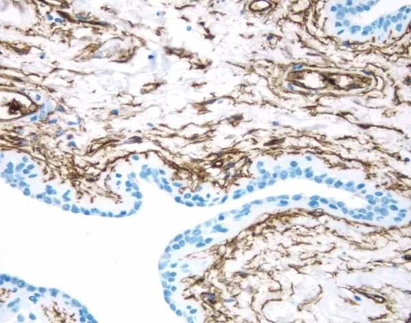 Breast Cancer: CD34 antigen stained using VECTASTAIN Elite ABC Kit and Vector DAB (brown) substrate. Hematoxylin QS (blue) counterstain.