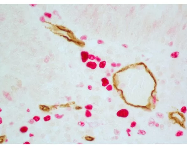 Colon Carcinoma (paraffin): ImmPRESS Duet Kit (MP-7724) used to detect mouse anti-CD34 (ImmPACT DAB, brown) and rabbit anti-Ki67 (ImmPACT Vector® Red, magenta) antibodies.