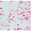 Colon Carcinoma (paraffin): ImmPRESS Duet Kit (MP-7724) used to detect mouse anti-CD34 (ImmPACT DAB, brown) and rabbit anti-Ki67 (ImmPACT Vector® Red, magenta) antibodies.