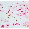 Colon Carcinoma (paraffin): ImmPRESS Duet Kit (MP-7724) used to detect mouse anti-CD34 (ImmPACT DAB, brown) and rabbit anti-Ki67 (ImmPACT Vector® Red, magenta) antibodies. Colon Carcinoma (paraffin): ImmPRESS Duet Kit (MP-7724) used to detect mouse anti-CD34 (ImmPACT DAB, brown) and rabbit anti-Ki67 (ImmPACT Vector® Red, magenta) antibodies.