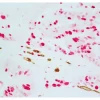 Colon Carcinoma (paraffin): ImmPRESS Duet Kit (MP-7724) used to detect mouse anti-CD34 (ImmPACT DAB, brown) and rabbit anti-Ki67 (ImmPACT Vector® Red, magenta) antibodies.