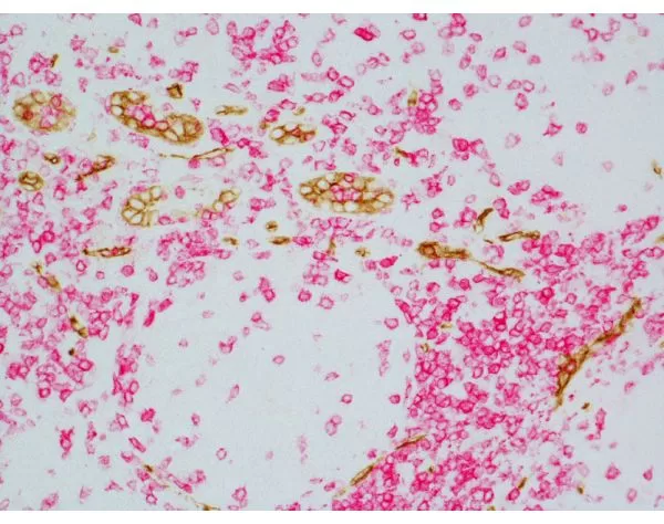 Tonsil (paraffin): ImmPRESS Duet Kit (MP-7724) used to detect mouse anti- CD34 (ImmPACT DAB, brown) and rabbit anti-CD3 (ImmPACT Vector® Red, magenta) antibodies.