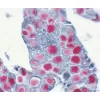 Tumor (double label): p53 protein (m), VECTASTAIN ABC-AP Kit, Vector Red substrate (red); Pan-Cytokeratin (m), VECTASTAIN Elite ABC Kit, Vector SG Substrate (blue/gray).