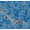 Melanoma was stained with anti-vimentin followed by ImmPRESS™-AP Anti-Rabbit IgG Reagent and Vector Blue Substrate. Note the excellent contrast of the substrate with the brown pigments.