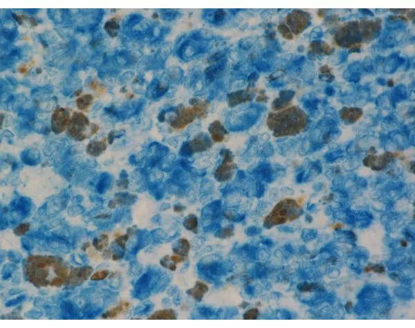 Melanoma: Anti-Vimentin (rabbit mab), ImmPRESS-AP Anti-Rabbit IgG, Vector Blue Substrate (blue).