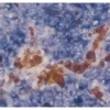 Melanoma was stained with anti-vimentin followed by ImmPRESS™-AP Anti-Rabbit IgG Reagent and BCIP/NBT Substrate. Note the excellent contrast of the substrate with the brown pigments.