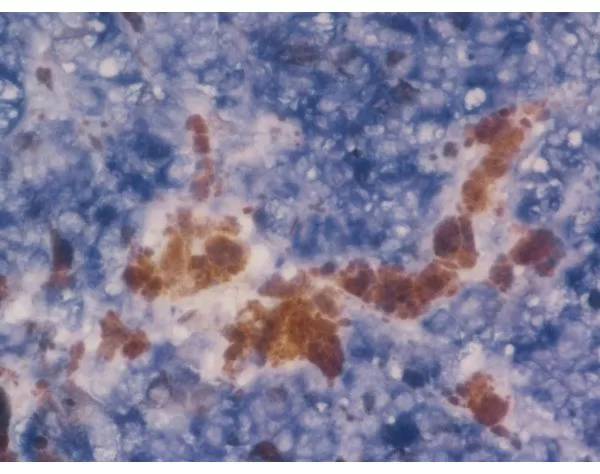 Melanoma was stained with anti-vimentin followed by ImmPRESS™-AP Anti-Rabbit IgG Reagent and BCIP/NBT Substrate. Note the excellent contrast of the substrate with the brown pigments.