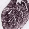Colon Carcinoma: Pan-Cytokeratin (m), VECTASTAIN ABC-AP Kit, Vector Black (brown-black).