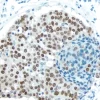 Breast Carcinoma: Estrogen receptor (rm), ImmPRESS Anti-Rabbit Ig Kit, DAB (brown) substrate. Hematoxylin QS (blue) counterstain. Breast Carcinoma: Estrogen receptor (rm), ImmPRESS Anti-Rabbit Ig Kit, DAB (brown) substrate. Hematoxylin QS (blue) counterstain.