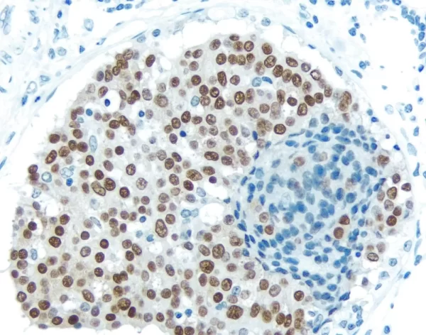Breast Carcinoma: Estrogen receptor (rm), ImmPRESS Anti-Rabbit Ig Kit, DAB (brown) substrate. Hematoxylin QS (blue) counterstain.