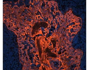 Tonsil (FFPE) was antigen retrieved with Antigen Unmasking Solution, and stained with Anti-Pan Cytokeratin mouse primary antibody (clone AE1/AE3), B-Horse x Mouse IgG and Cy3-Streptavidin. Mounted in VECTASHIELD HardSet Mounting Medium with DAPI. Tonsil (FFPE) was antigen retrieved with Antigen Unmasking Solution, and stained with Anti-Pan Cytokeratin mouse primary antibody (clone AE1/AE3), B-Horse x Mouse IgG and Cy3-Streptavidin.  Mounted in  VECTASHIELD  HardSet Mounting Medium with DAPI.