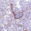 Lymphoma: Lymphatic endothelium stained using mouse monoclonal antibody against M2A antigen (clone D2-40; Cat. No. VP-M671), ImmPress anti-mouse Ig reagent (MP-7402), and Vector NovaRED peroxidase substrate (SK-4800; red). Hematoxylin QS counterstain (blu