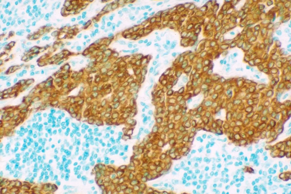 Tumor: Cytokeratin 18 (sheep), VECTASTAIN Elite ABC Kit for Sheep IgG, Vector DAB (brown), Vector Methyl Green counterstain (green).