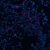 Colon Carcinoma (FFPE) was antigen retrieved with Antigen Unmasking Solution and stained with DyLight 649 labeled UEA I. Colon Carcinoma (FFPE) was antigen retrieved with Antigen Unmasking Solution and stained with DyLight 649 labeled UEA I.