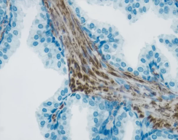 Tumor tissue section showing specific cytoplasmic cell staining (brown, Vector DAB) with Vector Hematoxylin QS (blue) counterstain. Tumor tissue section showing specific cytoplasmic cell staining (brown, Vector DAB) with Vector Hematoxylin QS (blue) counterstain.
