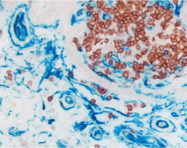 Colon (double label): Anti-CD3 (rabbit monoclonal), ImmPRESS (Peroxidase) Anti-Rabbit Ig, ImmPACT AMEC Red. Anti CD34 (mouse monoclonal), ImmPRESS-AP Anti-mouse Ig, Vector Blue (blue).