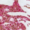 Breast Carcinoma (double label): Estrogen Receptor (m), ImmPRESS Universal Reagent, Vector DAB substrate (brown); Multi-Cytokeratin (m), VECTASTAIN Universal ABC-AP Kit, Vector Red substrate (red).
