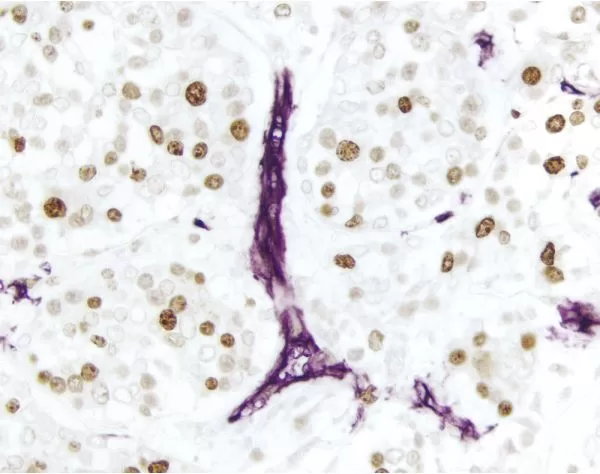 Breast Carcinoma (double label): Ki67 (rm), ImmPRESS Universal Reagent, DAB substrate (brown); CD34 (m), ImmPRESS Universal Reagent, Vector VIP substrate (purple).