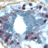 Breast Carcinoma (triple label): Estrogen Receptor (m); VECTASTAIN Elite ABC Kit, Vector NovaRED substrate (red); CD34 (m), VECTASTAIN Elite ABC Kit, DAB substrate (brown); Cytokeratin 8/18 (m), VECTASTAIN Elite ABC Kit, Vector SG substrate (blue/gray).