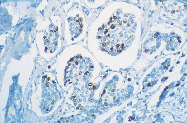 Human Breast Carcinoma: Ki67 (m), VECTASTAIN Universal Quick Kit with DAB (brown) substrate. Hematoxylin (blue) counterstain. Human Breast Carcinoma: Ki67 (m), VECTASTAIN Universal Quick Kit with DAB (brown) substrate. Hematoxylin (blue) counterstain.