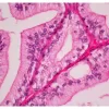 Prostate section stained with Hematoxylin & Eosin Stain Kit (cytoplasm, pink; nuclei, blue).