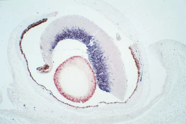 Mouse, Newborn (eye, double label): GFAP (m), MOM Peroxidase Kit, Vector NovaRED substrate (red); Synapsin (m), MOM Peroxidase Kit, DAB+Ni substrate (gray/black). Note contrast with endogenous pigment (brown) seen in surrounding tissues.