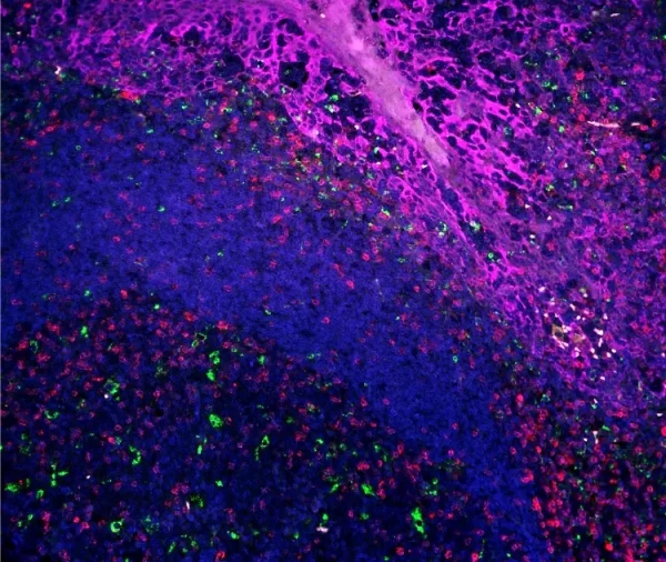 Image captured after completion of 3 rounds of tyramide staining. VectaPlex™ was used after each round. FFPE tonsil; 3 mouse primary antibodies (CD3 (Red), CD68 (Green), AE1/AE3 (Purple)); detected using Opal 3-Plex TSA Kit.
