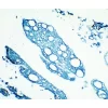 Tumor Cytokeratin s Vectastain Elite Abc Kit Tmb blue Tumor Cytokeratin s Vectastain Elite Abc Kit Tmb blue