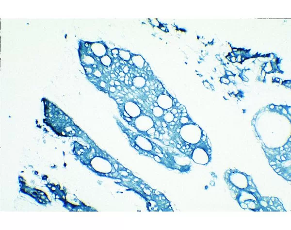 Tumor: Cytokeratin (s), VECTASTAIN Elite ABC Kit, TMB (blue).